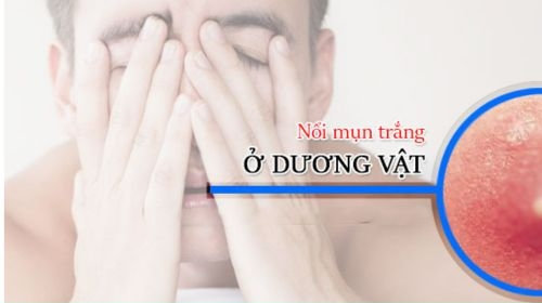 Dương vật nổi mụn trắng: Dấu hiệu cảnh báo bệnh lý nguy hiểm!