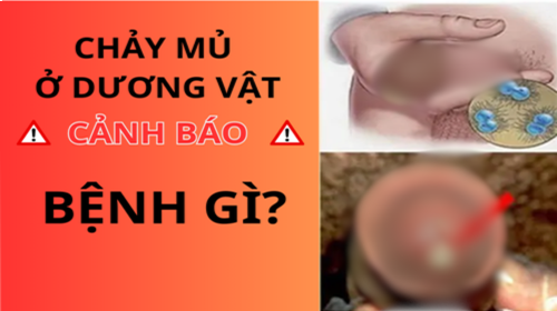 Dương vật rỉ mủ là biểu hiện của bệnh nào? Nguyên nhân và cách chữa trị