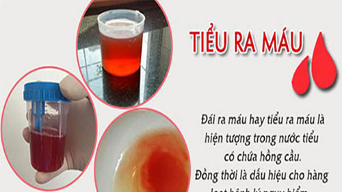 Tiểu rắt: Nguyên nhân, triệu chứng và cách điều trị