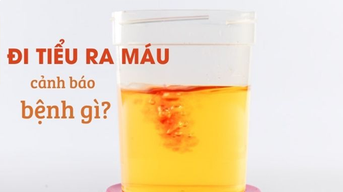 Tiểu ra máu ở nam giới làm sao hết?
