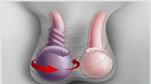 Bị đau 1 bên tinh hoàn: Tín hiệu “cảnh báo” bệnh nam khoa nguy hiểm