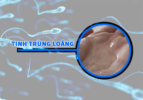 Bác sĩ chuyên khoa giải đáp: Bị tinh trùng loãng có ảnh hưởng đến sức khoẻ không?