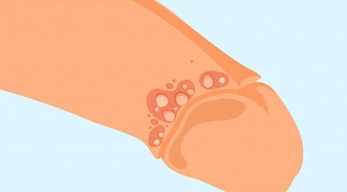 Nam giới bị nổi mụn ở bao quy đầu: Đâu là nguyên nhân?