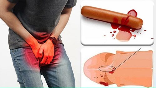 Chảy máu bao quy đầu có sao không? Nguyên nhân và cách xử lý