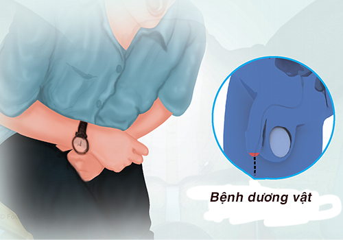 Dấu hiệu nhận biết mắc viêm bao quy đầu – Bác sĩ hướng dẫn cách xử trí