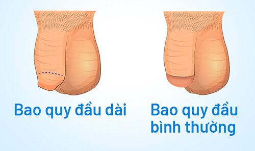 Dài bao quy đầu có sao không? Nguyên nhân và cách chữa trị