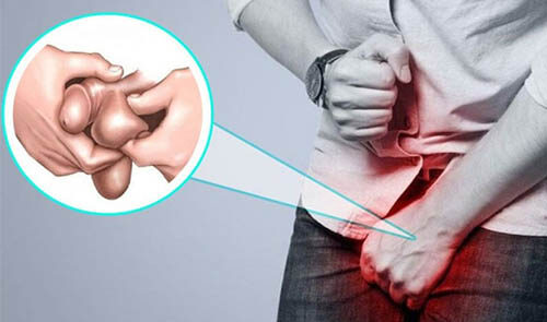 Nam giới bị đau tinh hoàn: Chớ nên xem nhẹ!