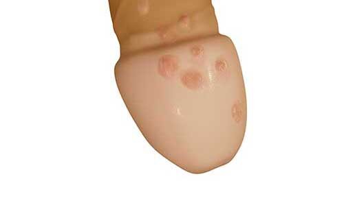 Lở loét bao quy đầu là dấu hiệu của bệnh lý nguy hiểm nào?