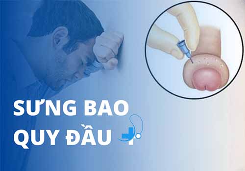 Sưng bao quy đầu có nguy hiểm không? Nguyên nhân và cách khắc phục