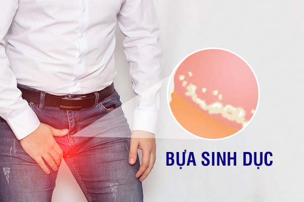 Bựa trắng ở bộ phận sinh dục là dấu hiệu bệnh gì?