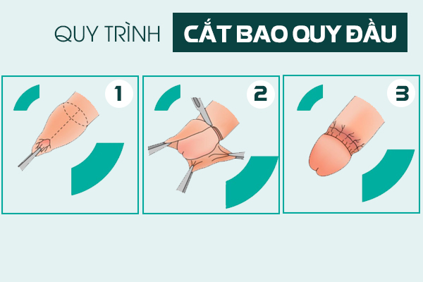 Địa chỉ cắt bao quy đầu ở đâu tại Đắk Lắk