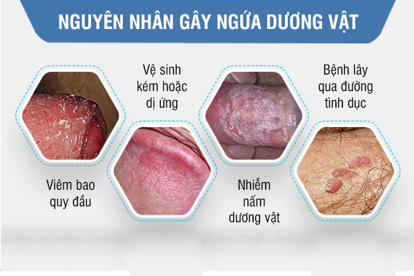 Quan hệ bị ngứa ở nam là bị gì?