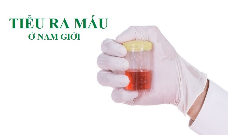 TIỂU RA MÁU Ở NAM GIỚI – NGUYÊN NHÂN VÀ CÁCH CHỮA